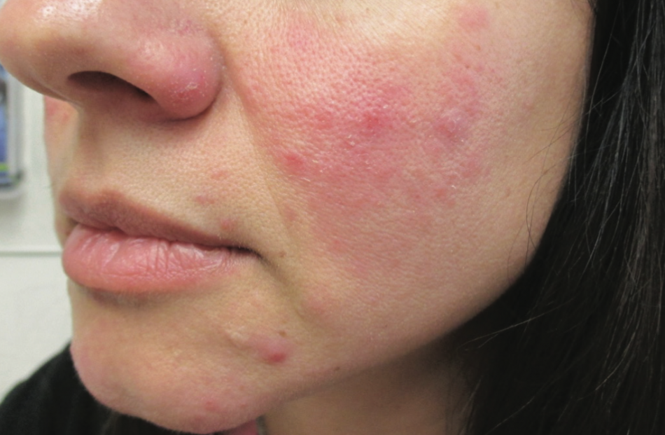 Rosacea Symptoms What Causes Rosacea Treatment For Rosacea